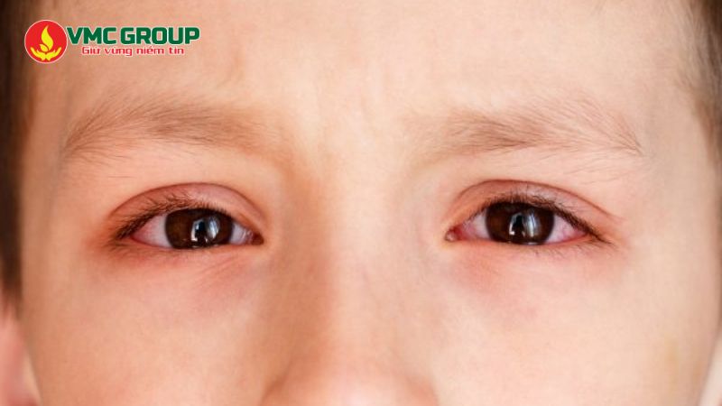 Clo có thể gây đỏ mắt