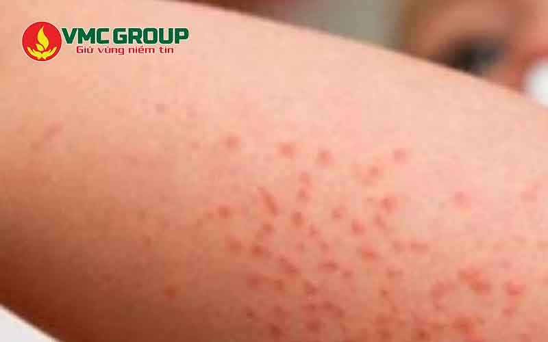 Đèn UV ngăn ngừa kích ứng da khi bơi