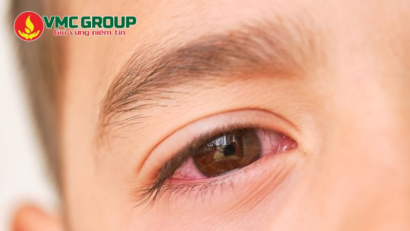 Mắt trẻ bị đỏ do nhiễm Adenovirus Mắt trẻ bị đỏ do nhiễm Adenovirus